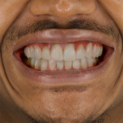 Dental Simulation - Example 2