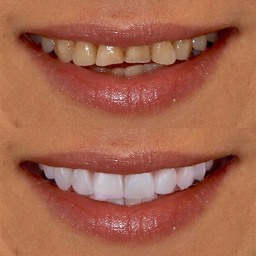 Dental Simulation - Example 1